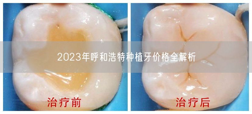 2023年呼和浩特种植牙价格全解析(图1)