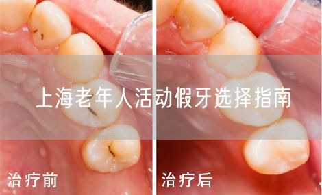 上海老年人活动假牙选择指南(图1)