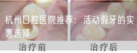 杭州口腔医院推荐：活动假牙的实惠选择(图1)