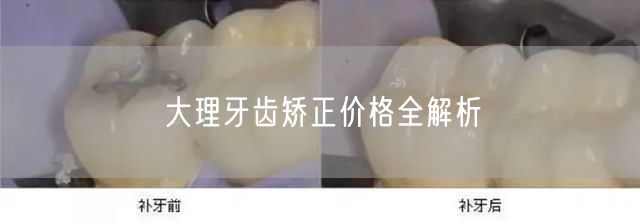大理牙齿矫正价格全解析(图1)