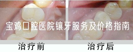 宝鸡口腔医院镶牙服务及价格指南(图1)