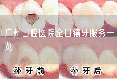 广州口腔医院全口镶牙服务一览(图1)