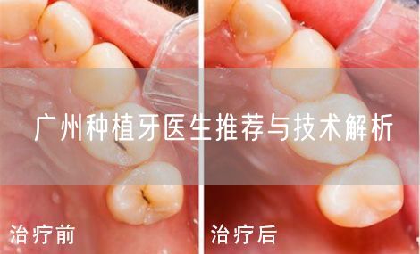广州种植牙医生推荐与技术解析