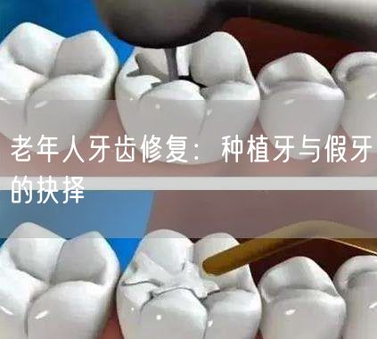 老年人牙齿修复：种植牙与假牙的抉择