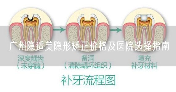 广州隐适美隐形矫正价格及医院选择指南