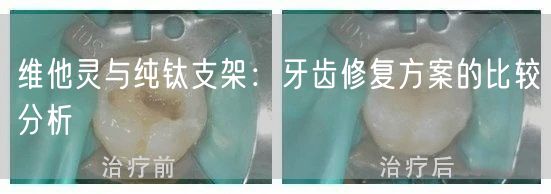 维他灵与纯钛支架：牙齿修复方案的比较分析(图1)