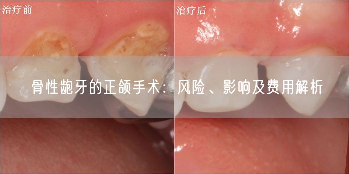 骨性龅牙的正颌手术：风险、影响及费用解析
