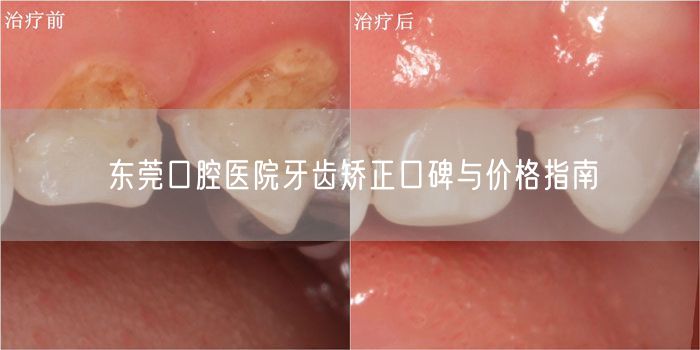 东莞口腔医院牙齿矫正口碑与价格指南