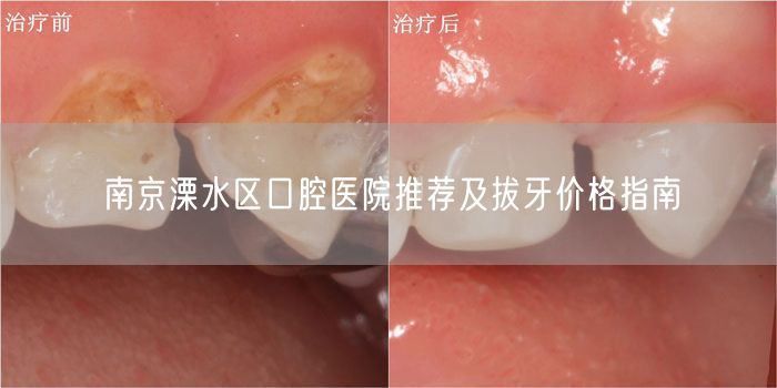 南京溧水区口腔医院推荐及拔牙价格指南(图1)