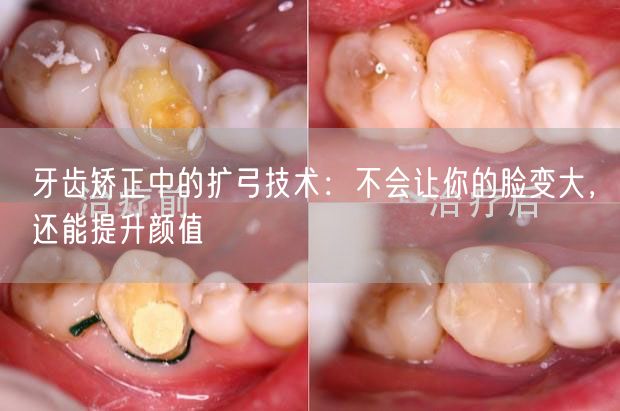 牙齿矫正中的扩弓技术：不会让你的脸变大，还能提升颜值