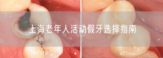 上海老年人活动假牙选择指南