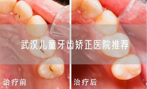 武汉儿童牙齿矫正医院推荐(图1)