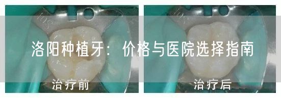 洛阳种植牙：价格与医院选择指南