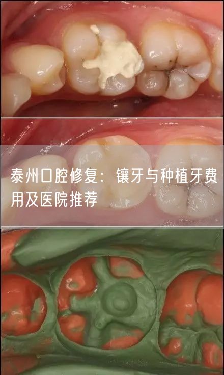 泰州口腔修复：镶牙与种植牙费用及医院推荐