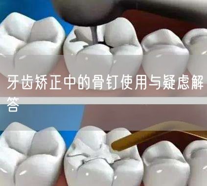 牙齿矫正中的骨钉使用与疑虑解答(图1)