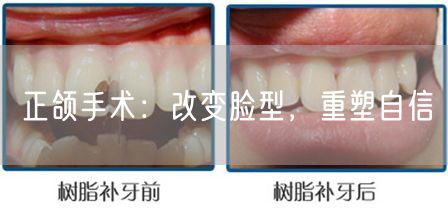 正颌手术：改变脸型，重塑自信(图1)