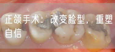 正颌手术：改变脸型，重塑自信