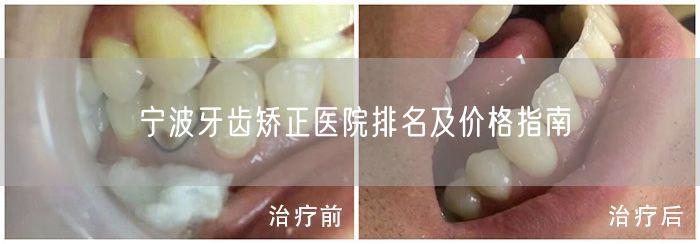 宁波牙齿矫正医院排名及价格指南