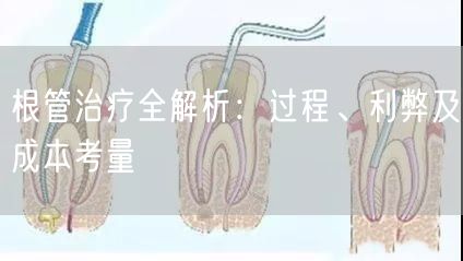 根管治疗全解析：过程、利弊及成本考量(图1)
