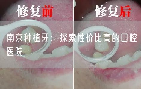 南京种植牙：探索性价比高的口腔医院(图1)