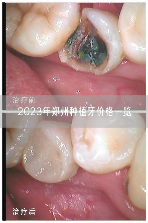2023年郑州种植牙价格一览