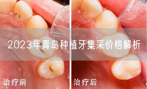 2023年青岛种植牙集采价格解析