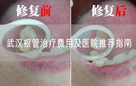 武汉根管治疗费用及医院推荐指南
