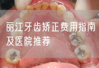 丽江牙齿矫正费用指南及医院推荐(图1)