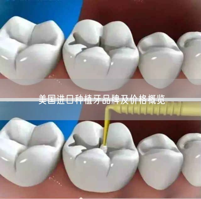 美国进口种植牙品牌及价格概览(图1)