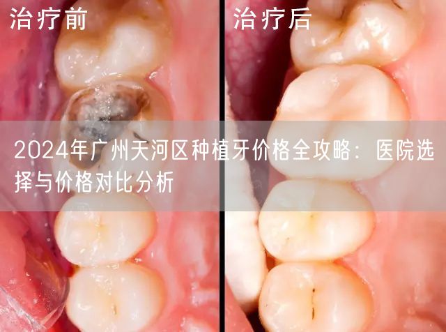 2024年广州天河区种植牙价格全攻略：医院选择与价格对比分析