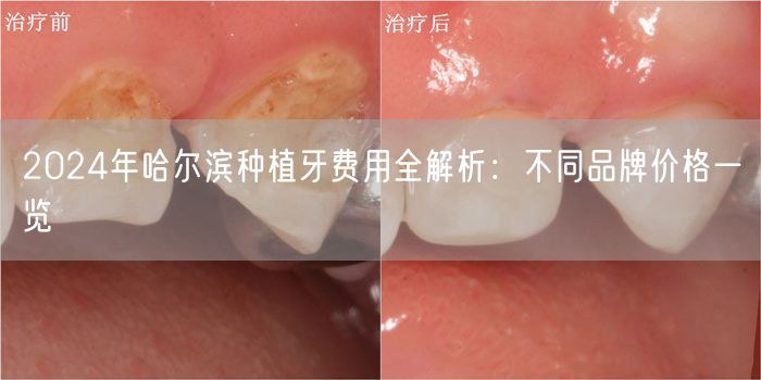 2024年哈尔滨种植牙费用全解析：不同品牌价格一览