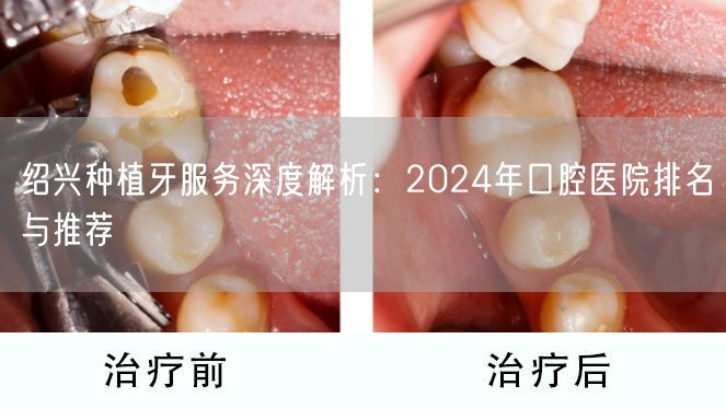 绍兴种植牙服务深度解析：2024年口腔医院排名与推荐