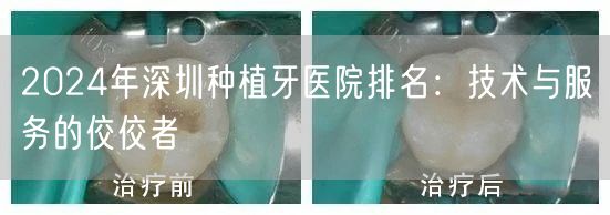 2024年深圳种植牙医院排名：技术与服务的佼佼者