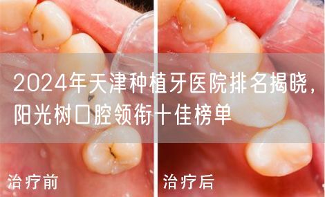 2024年天津种植牙医院排名揭晓，阳光树口腔领衔十佳榜单