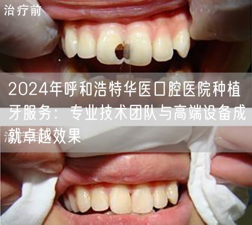 2024年呼和浩特华医口腔医院种植牙服务：专业技术团队与高端设备成就卓越效果