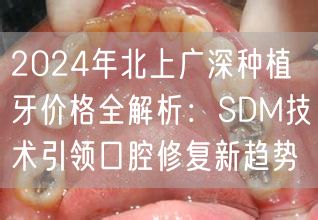 2024年北上广深种植牙价格全解析：SDM技术引领口腔修复新趋势