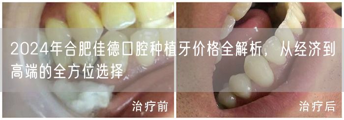 2024年合肥佳德口腔种植牙价格全解析，从经济到高端的全方位选择