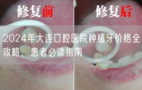 2024年大连口腔医院种植牙价格全攻略，患者必读指南