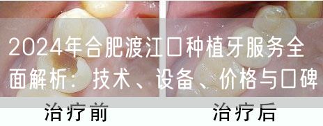 2024年合肥渡江口种植牙服务全面解析：技术、设备、价格与口碑