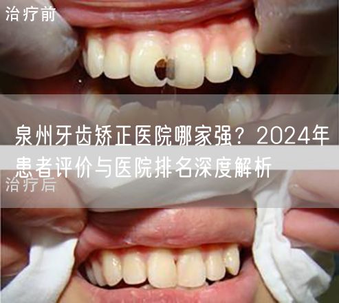 泉州牙齿矫正医院哪家强？2024年患者评价与医院排名深度解析