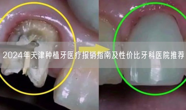 2024年天津种植牙医疗报销指南及性价比牙科医院推荐