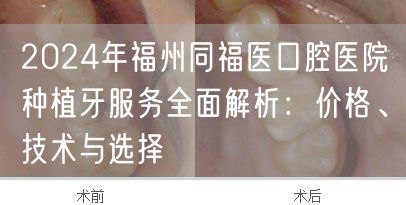 2024年福州同福医口腔医院种植牙服务全面解析：价格、技术与选择
