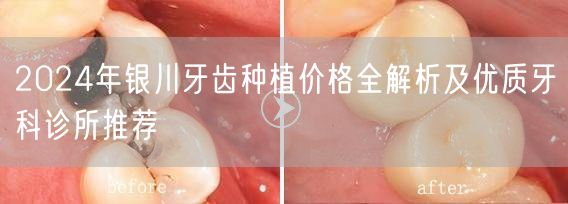 2024年银川牙齿种植价格全解析及优质牙科诊所推荐