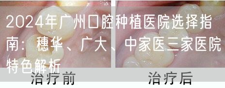 2024年广州口腔种植医院选择指南：穗华、广大、中家医三家医院特色解析
