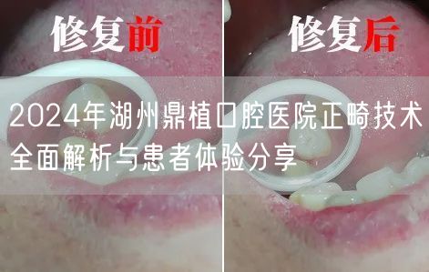 2024年湖州鼎植口腔医院正畸技术全面解析与患者体验分享