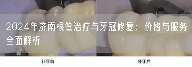 2024年济南根管治疗与牙冠修复：价格与服务全面解析