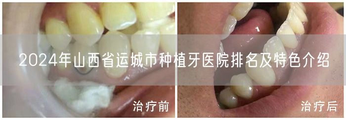 2024年山西省运城市种植牙医院排名及特色介绍