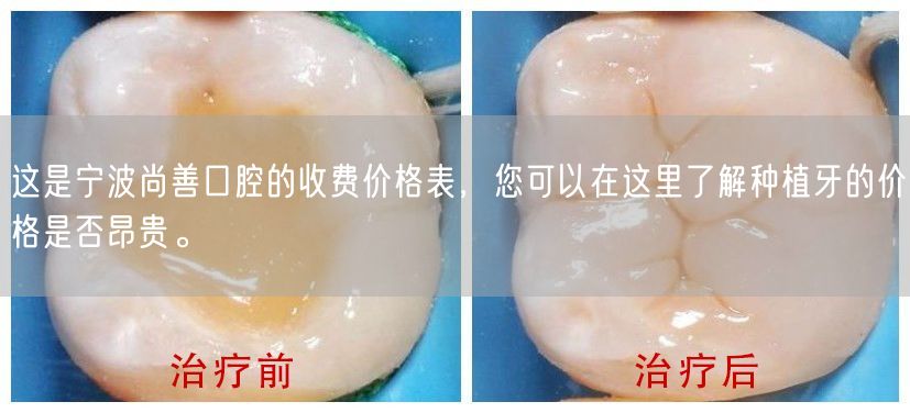这是宁波尚善口腔的收费价格表，您可以在这里了解种植牙的价格是否昂贵。