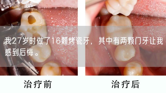 我27岁时做了16颗烤瓷牙，其中有两颗门牙让我感到后悔。