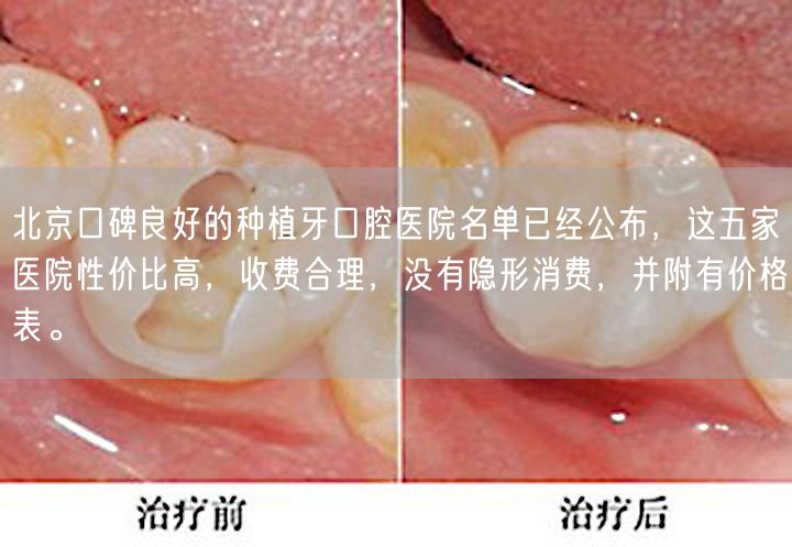 北京口碑良好的种植牙口腔医院名单已经公布，这五家医院性价比高，收费合理，没有隐形消费，并附有价格表。